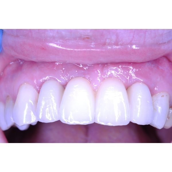 Циркониевый мостовидный протез Циркониевый мостовидный протез