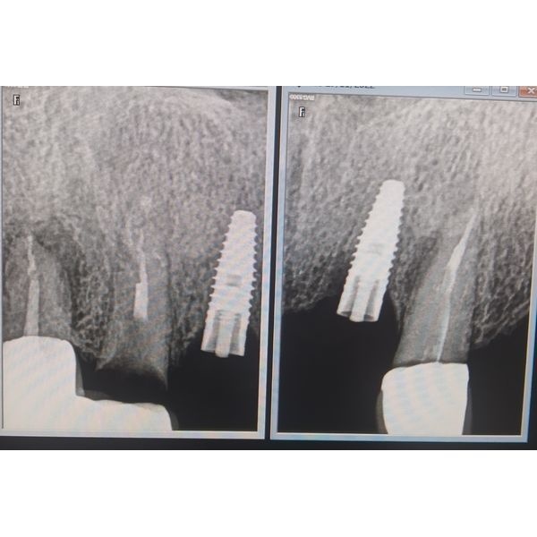Отломки винтов на месте зуба 1.2 и 2.2, к которым крепились коронки имплантатов