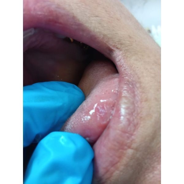 Пятно с налётом и красной каёмкой на кончике языка Пятно с налётом и красной каёмкой на кончике языка