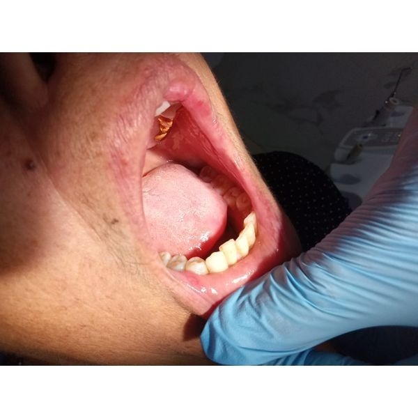 Состояние полости рта после лечения Состояние полости рта после лечения