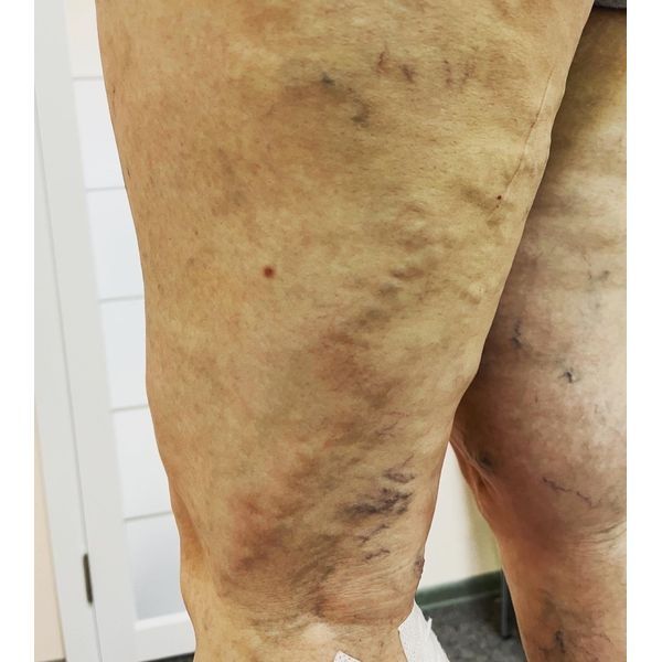 Острый тромбофлебит притока БПВ Острый тромбофлебит притока БПВ