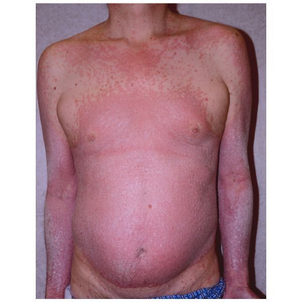 Распространённые высыпания до начала лечения