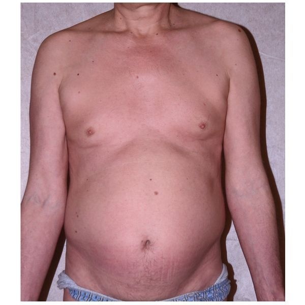 Через 20 недель после начала терапии