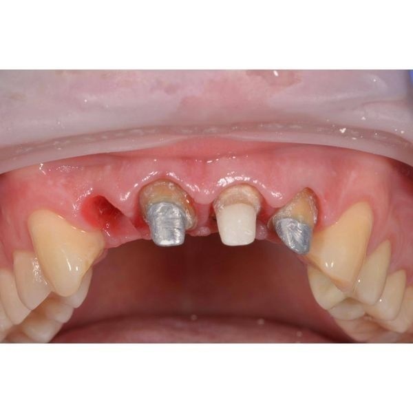 Фиксация постоянных коронок