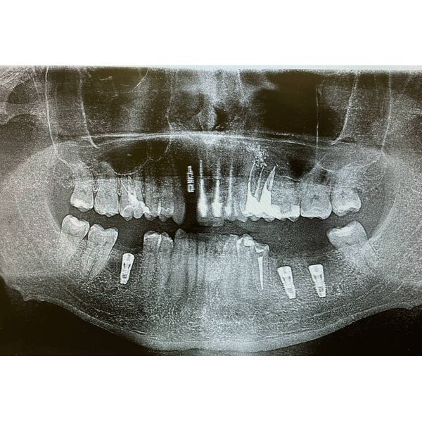 Рентген-снимок