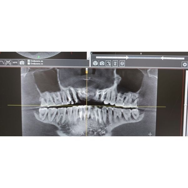 Компьютерная томография после депульпирования и шинирования центральной группы зубов Компьютерная томография после депульпирования и шинирования центральной группы зубов