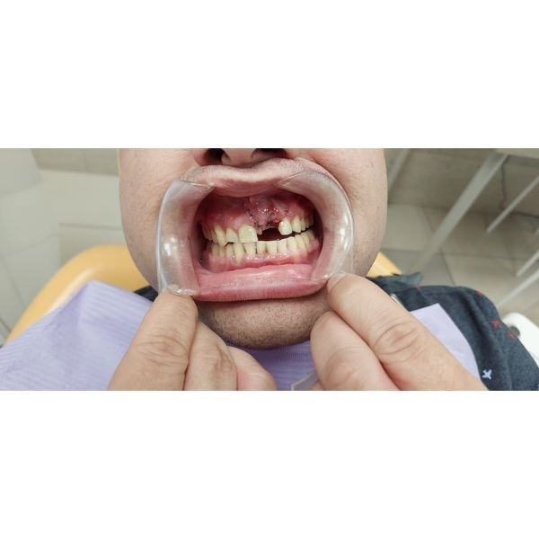 Зубные ряды через 3 дня после обращения Зубные ряды через 3 дня после обращения