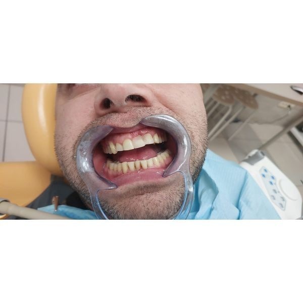 Зубные ряды через 2 месяца после обращения Зубные ряды через 2 месяца после обращения