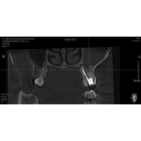 Корональная плоскость в декабре 2021 года