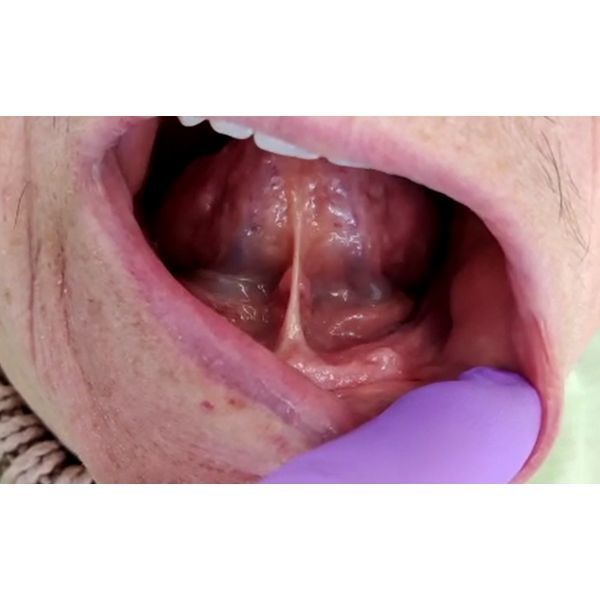 Атрофия альвеолярного отростка нижней челюсти