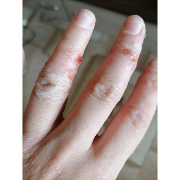 Кожа до лечения