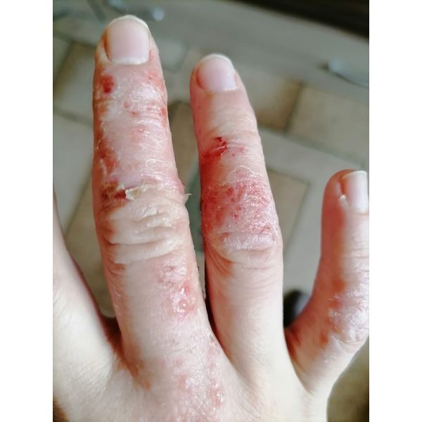 Кожа до лечения