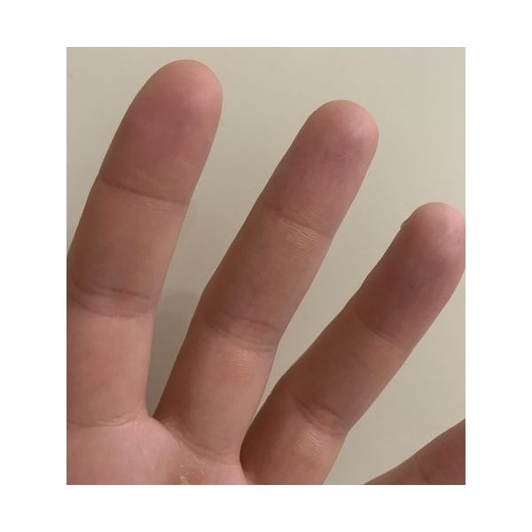 Кожа через 2 недели после терапии