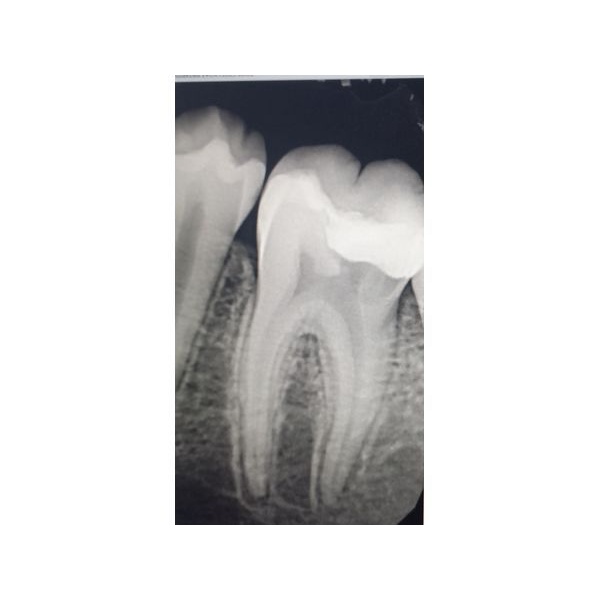 Рентгенография зуба 3.6 до лечения