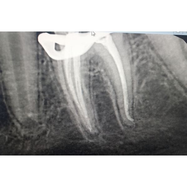 Рентгенографический контроль пломбирования корневых каналов
