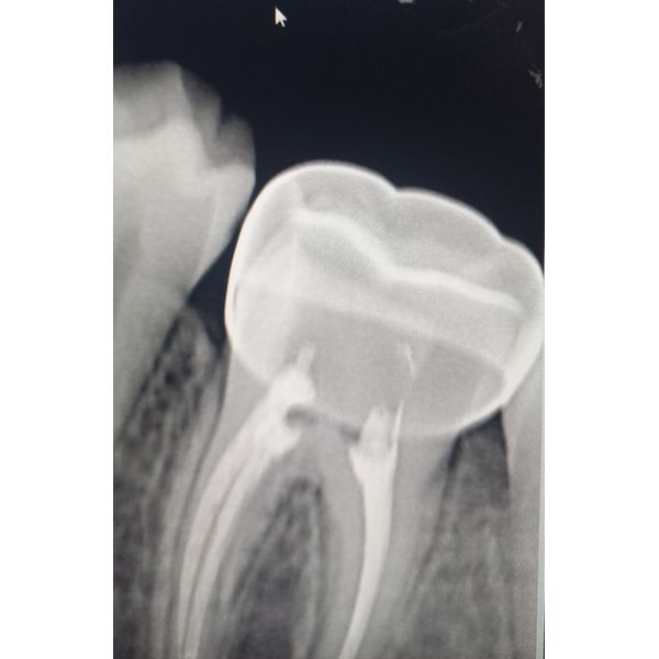 Рентгенографический контроль установленной стандартной стальной коронки