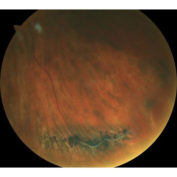 Периферическая витреохориоретинальная дистрофия до лечения