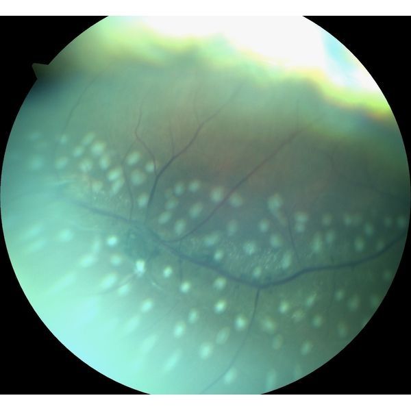 Свежие коагуляты после лечения