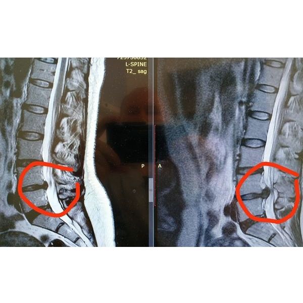 Уменьшение грыжи через полгода после начала лечения Уменьшение грыжи через полгода после начала лечения