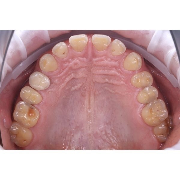 Исходная ситуация (верхняя челюсть)