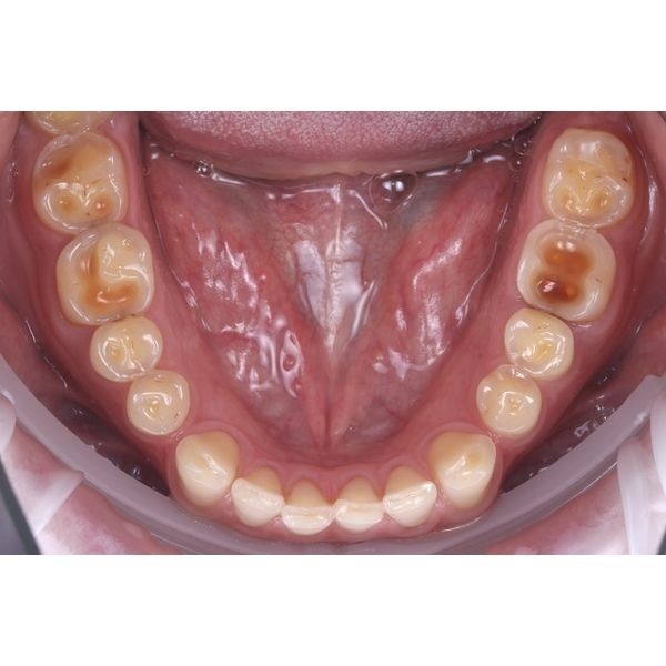 Исходная ситуация (нижняя челюсть)