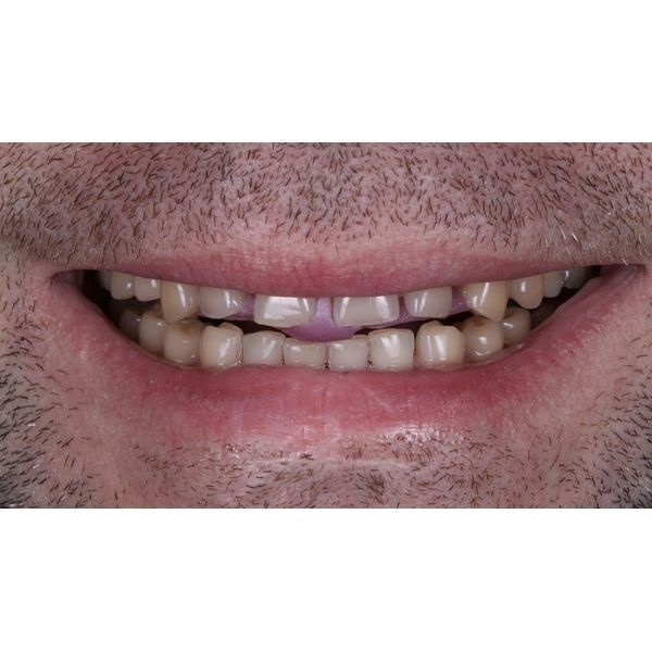 Изготовленный депрограмматор 