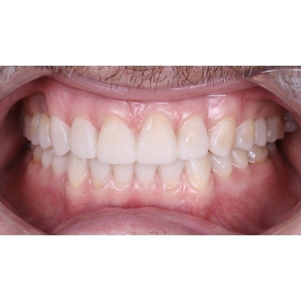 Установленный макет на зубах