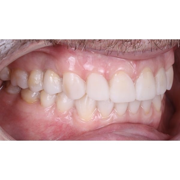 Установленный макет на зубах