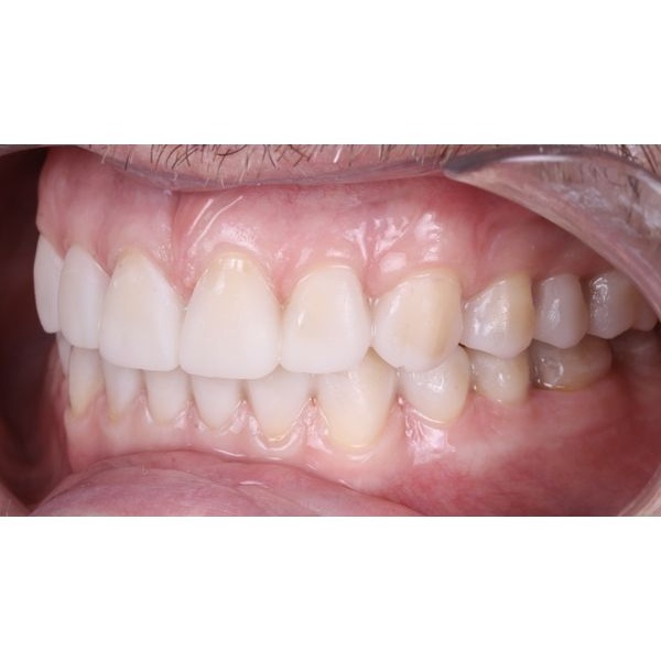 Установленный макет на зубах