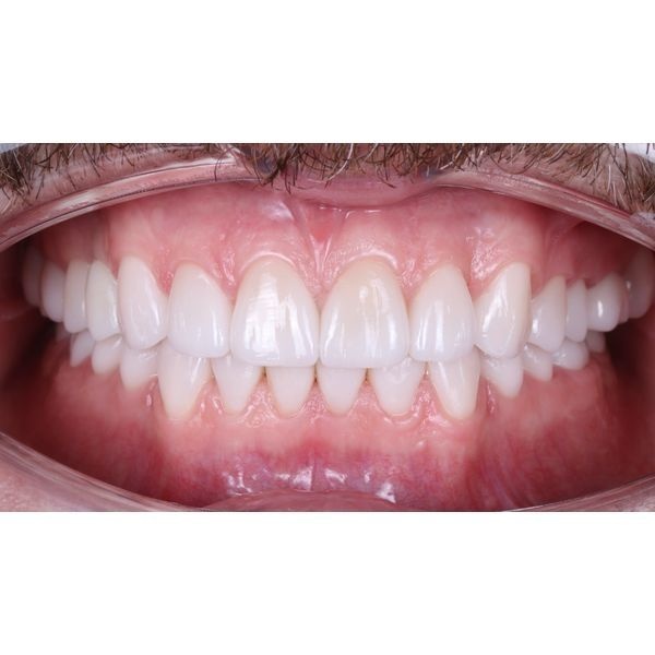 Постоянные керамические реставрации