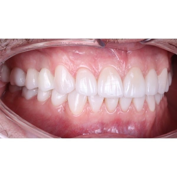 Постоянные керамические реставрации