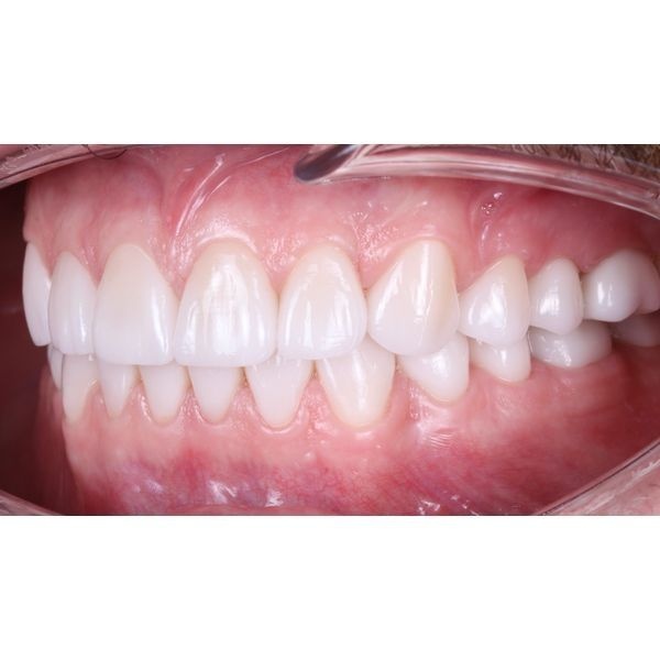 Постоянные керамические реставрации