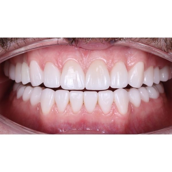 Постоянные керамические реставрации