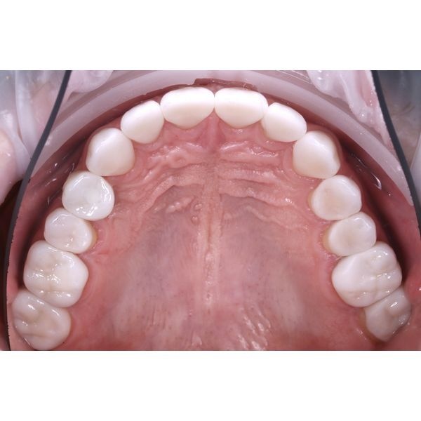 Постоянные керамические реставрации (верхняя челюсть)