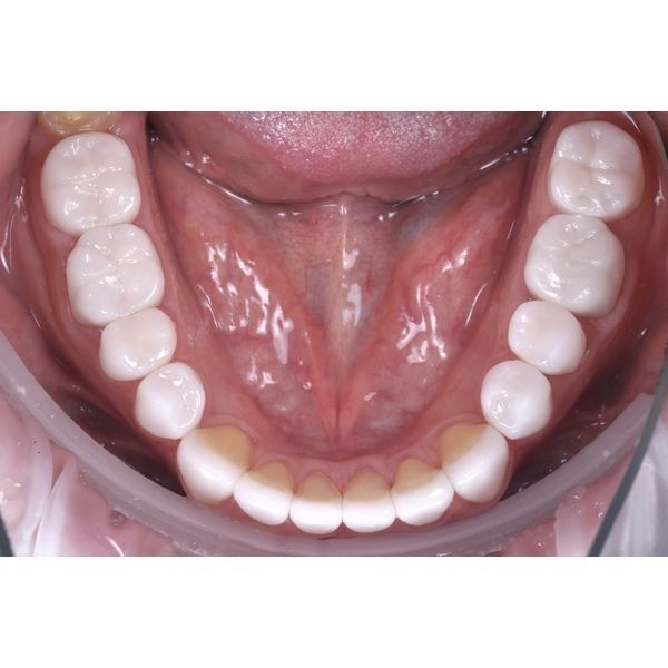 Постоянные керамические реставрации (нижняя челюсть)