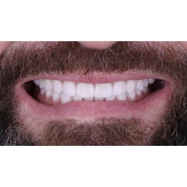 Финальное фото улыбки