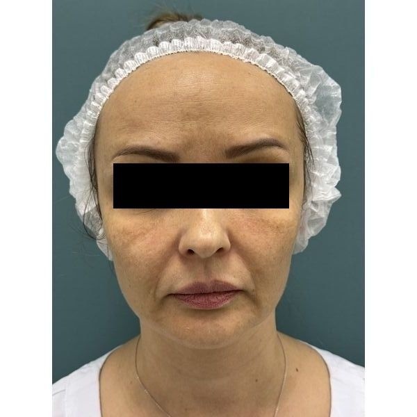 До лечения До лечения