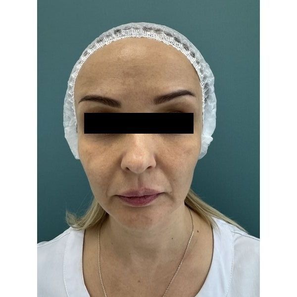 После лечения После лечения