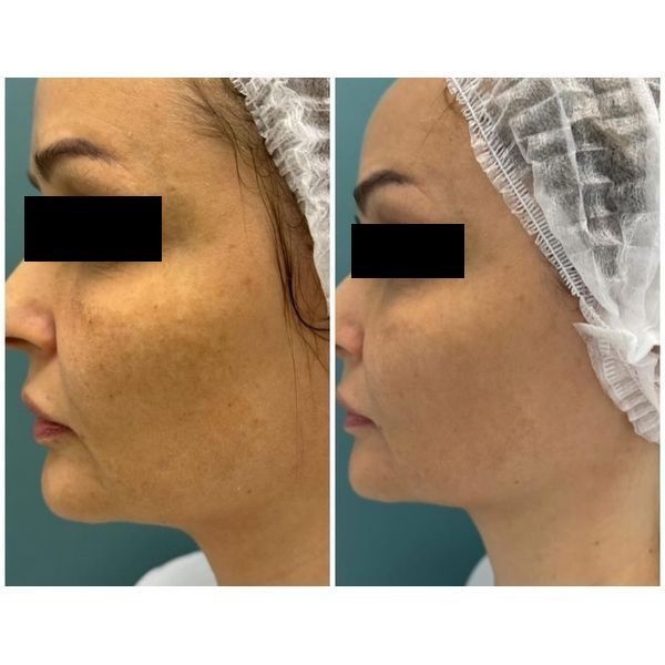 До и после лечения До и после лечения