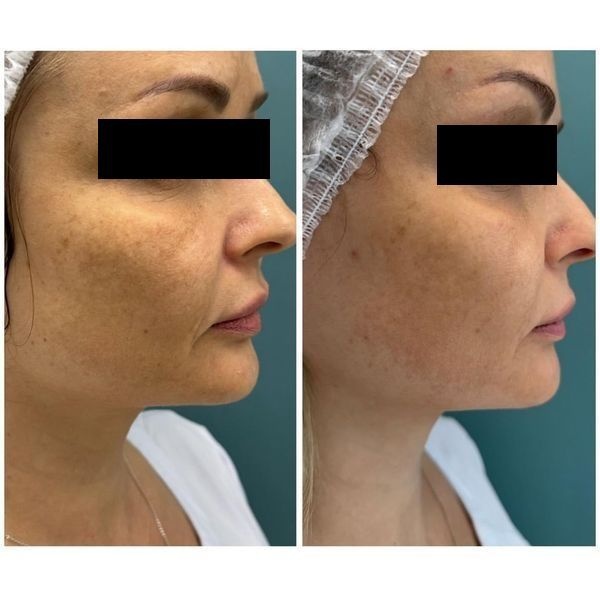 До и после лечения До и после лечения