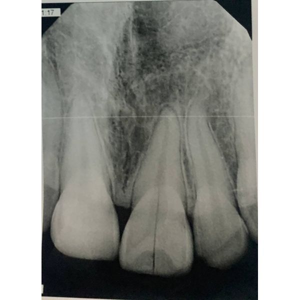 Снимок повреждённого зуба 