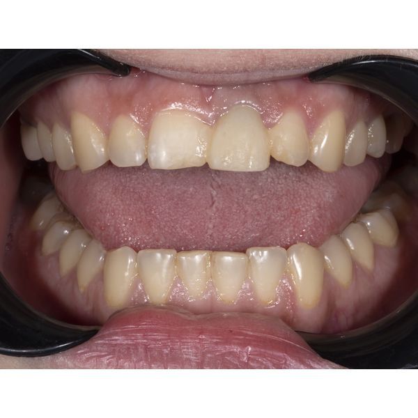 Временная коронка