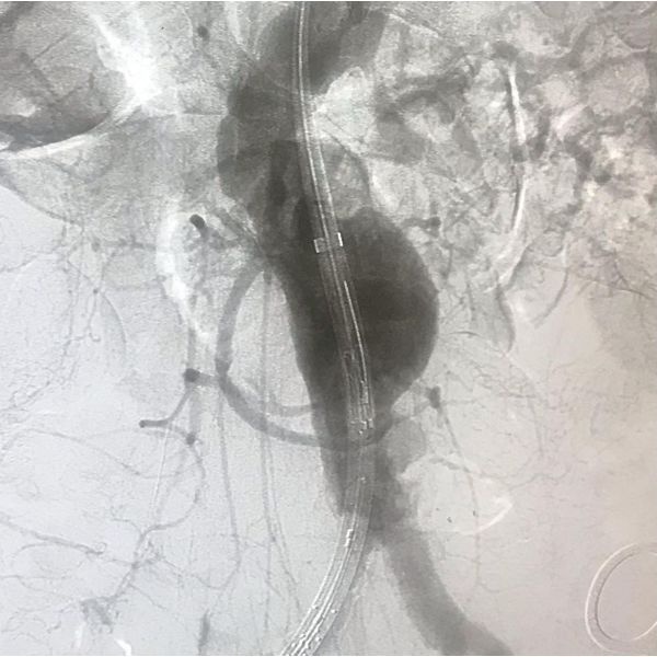 Аневризма брюшной аорты до имплантации стент-графта