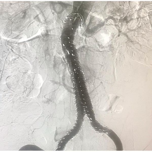 Аорта после имплантации стент-графта