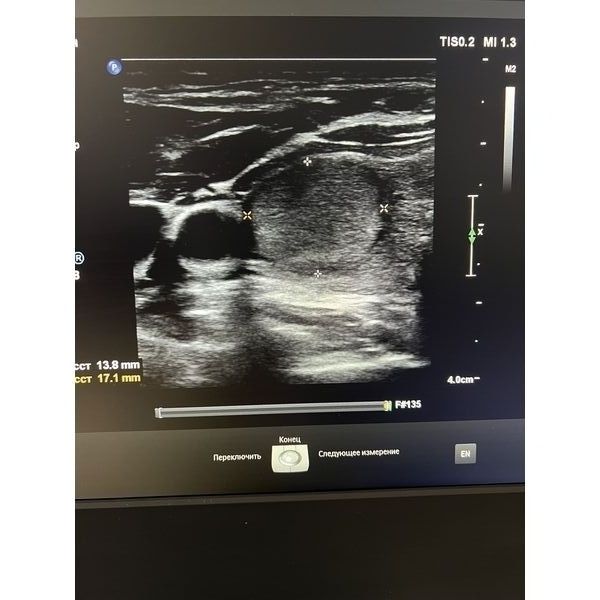 Изоэхогенное образование с гипоэхогенным ободком 