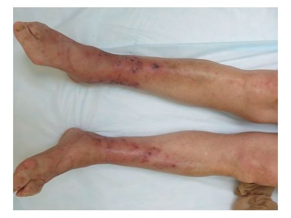 Внешний вид голеней до лечения
