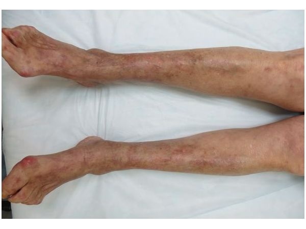 Внешний вид голеней после лечения