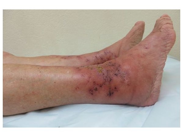 Правая голень до лечения