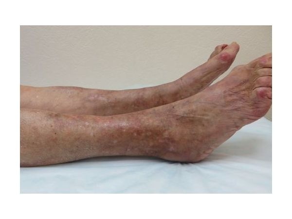 Правая голень после лечения