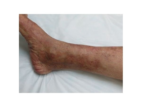 После лечения